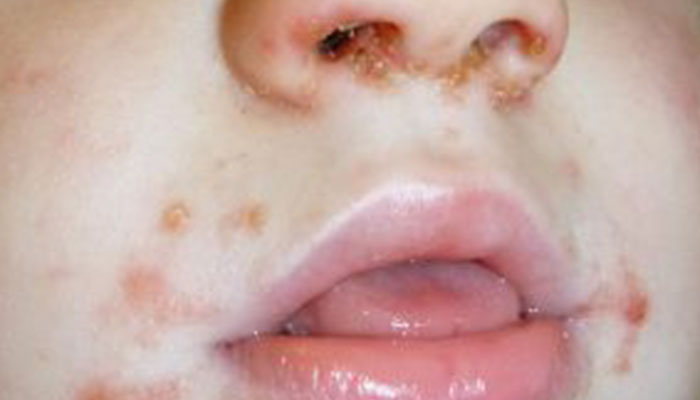 IMPETIGO